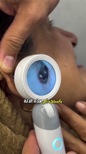 استخد الطبيب موجات خاصة لإخراج الحشرة من الأذن!