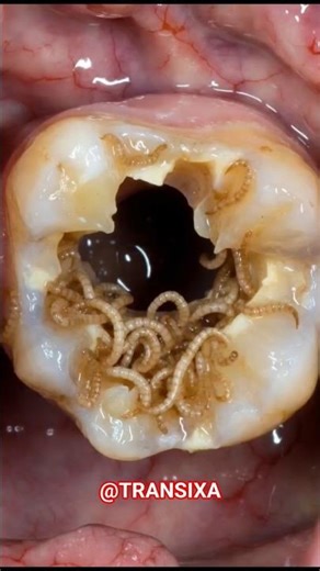 Maggots Removed from Rotten Tooth! 😱 Dental #MaggotsInTooth #OralMyiasis #RootCanal #Dentist #Viral