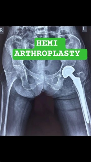 HEMI ARTHROPLASTY #subscribe #doctor #ytshorts