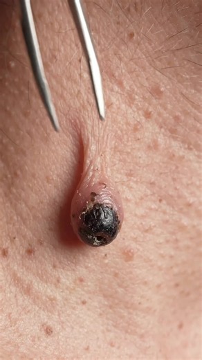 This blackhead came out on a stalk 😳 Giant blackhead plug pulled out in one piece with tweezers #oddlysatisfying #blackheadsremoval #pimplepop #extraction #oddlysatisfyingvideos