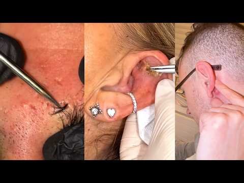 Popping huge blackheads and Pimple Popping - Best Pimple Popping Videos 293