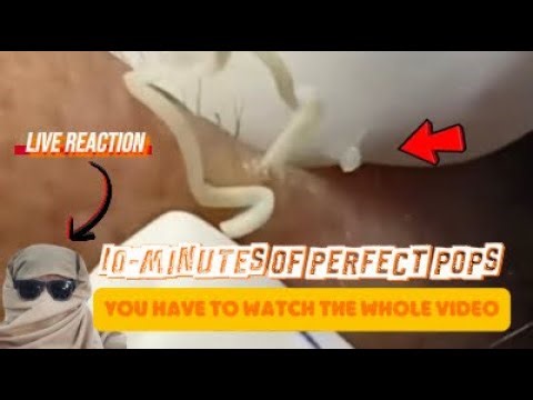 Massive Blackhead Extractions & Juicy Pimple Pops (10 Minutes) 😩