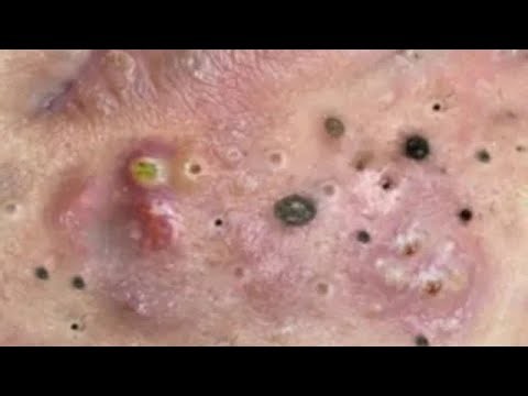 Deep blackhead Removal 2026, acne removal spa, big pimple 2026, #acne #pimple #cyst