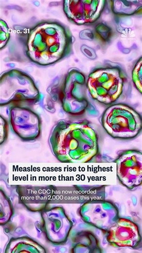Measles cases rise to highest level in more than 30 years
