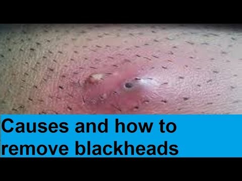 causes and how to remove blackheads