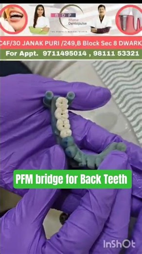 PFM Bridge for Back Teeth #newteeth #missingteeth