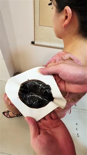 🤯 Huge Blackhead Extraction Gone Right | Oddly Satisfying Skincare Cleaning 🖤🔥