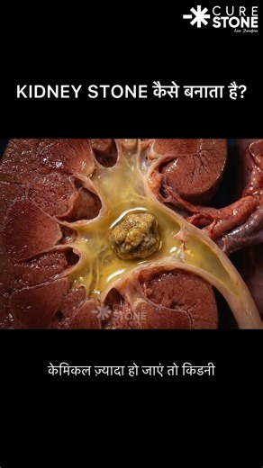 How kidney stones are formed?Animation