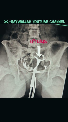 HSG PROCEDURE finding description check