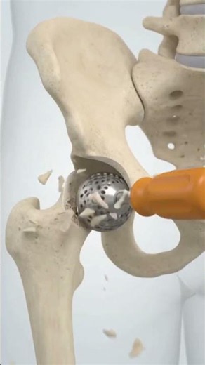3D Medical Animation Video Posterior Hip Replacement Surgery 🦴🦿🏥🩺
