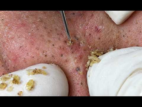 NEW 2026 🔥 Deep Acne Extraction & Satisfying Pimple Removal#10357