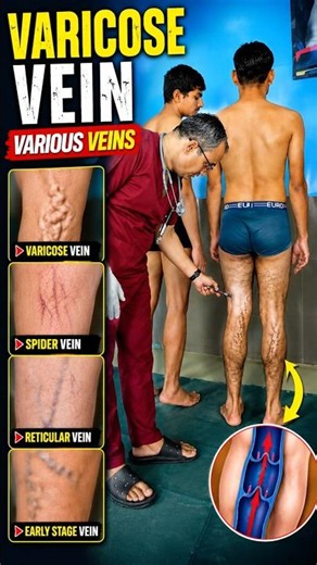 👁️Varicose Veins Explained | 👮‍♀️Army, SSC GD, Delhi Police Medical❌