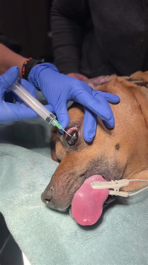 Therapeutic Ocular Paracentesis for Intraocular Pressure