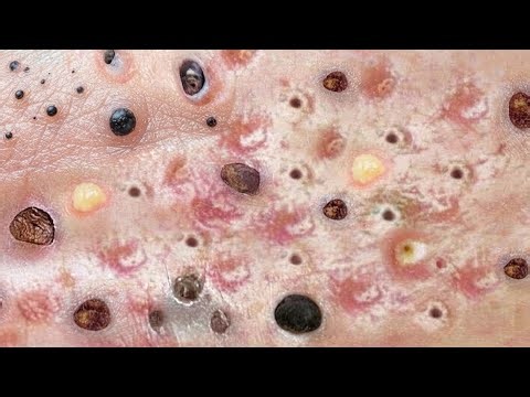 Extreme Blackhead Removal & Deep Pore Cleaning 🖤 | Satisfying ASMR Compilation