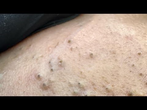 Say Goodbye To Acne: Korean Skincare Solutions For Sensitive, Oily Skin