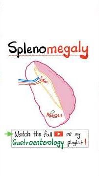 Splenomegaly - Hepatosplenomegaly - Liver Cirrhosis - Liver Function Tests (LFTs), Albumin, ALT, AST