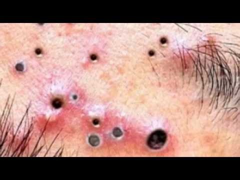 Deep blackhead Removal 2026, acne removal spa, big pimple 2026, #acne #pimple #cyst