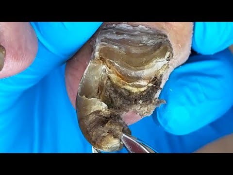 Perfect Transformation For Super Thick Onychomycosis!【Xue Yidao】
