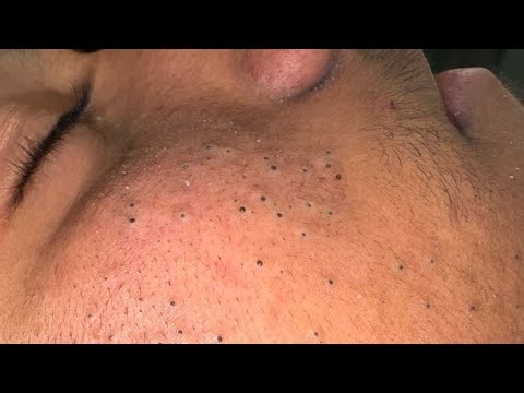 my BLACKHEAD REMOVAL + skin routine | EVERYTHING routine for deep pore clarity faster + Clear glow
