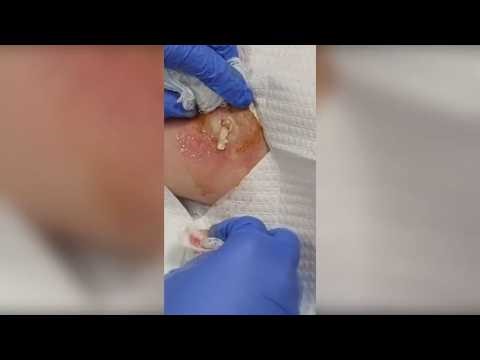 Satisfying Pimple Popping & Cyst Extractions - 182
