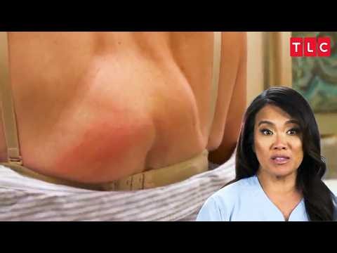 Dr. Lee Meets Her Match in These Stubborn Cysts | Dr. Pimple Popper S2 | TLC India