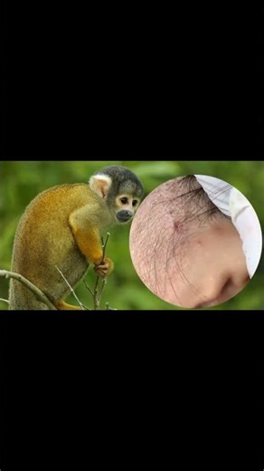 Removing Acne Blackheads on skin, cleaning everywhere