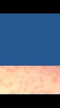 Health headlines: Measles deaths, CTE risk and diabetes research