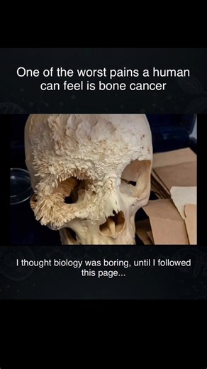Why Bone Cancer Is The Worst Pain Known To Humans... 💀 #science #facts