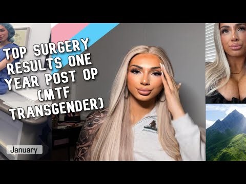 TOP SURGERY RESULTS ONE YEAR POST OP (MTF TRANSGENDER)