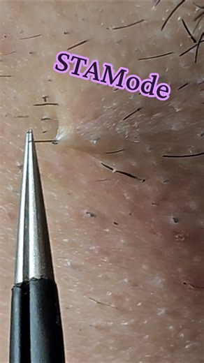 Deep Ingrown Hair Removal with Tweezers 😬🧔 #beard #tweezing #plucking #satisfying #fyp