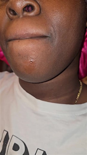 Pimple extract with me😁 Oddly satisfying 😌 #pimplepopping #extraction #pimple #pimpletok