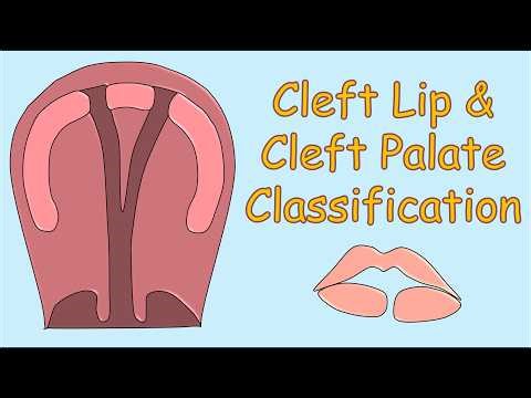 Cleft lip and Cleft Palate Classifications - Part 1