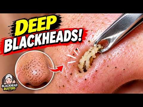 Are You Ready for This? Extreme Blackhead & Pimple Popping Compilation! #video #blackheadremoval