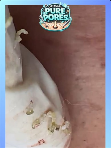 #20 - Shorts2 - Official Pure Pores Skin Care React to Soothing facial treatments ASMR @officialpurepores #blackheadremoval #acneextraction Voice reaction and animations to Extreme blackhead removal, deep pore cleansing, intense acne extraction and satisfying skincare close-ups captured in HD and 4K macro detail. This video features real pimple popping, whitehead extraction, nose pore cleaning and deep skin cleansing designed to be relaxing and oddly satisfying. Watch clogged pores transform thr