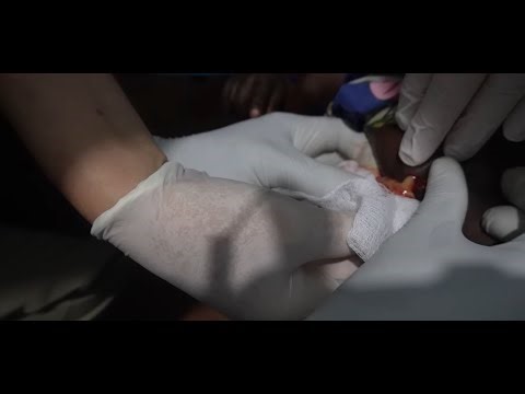 Pus about? let it out