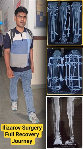 Ilizarov Surgery Full Recovery In Tibia bone Compound Fracture 7 inch new bone formation