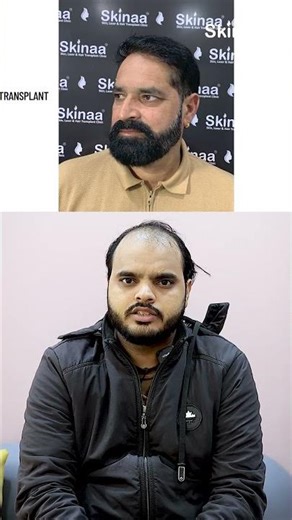 Hair Transplant Journey – Real Patient Review | Skinaa clinic