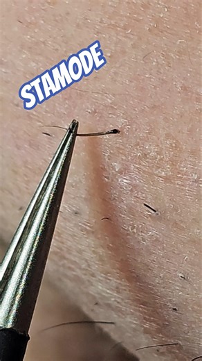 Ingrown Beard Hair — Exact Extraction Moment 😬