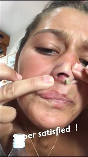 #blackheads #acne #poping #acnenose #pimple #blackheadvine #blackhead