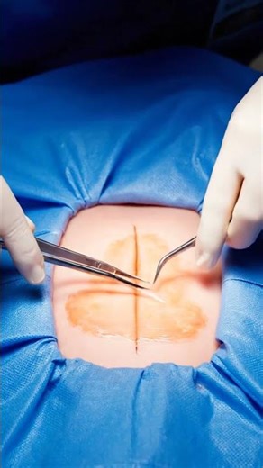 Deep Blackhead Removed From Ear #pimpleextraction #deepcleaning #beauty