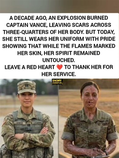 She Survived an Explosion With 75% Burns – Ten Years Later, She's Still in Uniform. Leave a ❤️