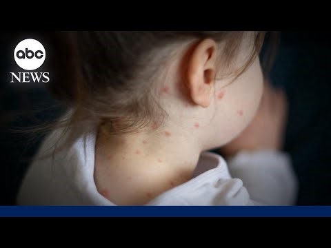 Measles outbreak in South Carolina is over, health officials say