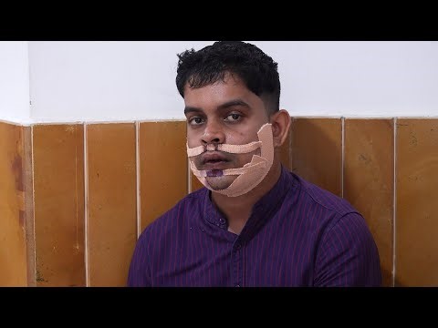 Jaw Surgery Changed My Face | Before & After (India)