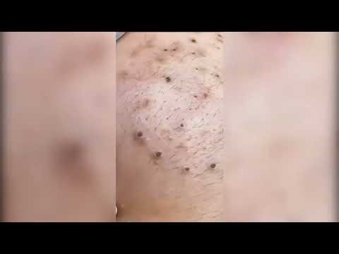 Satisfying Pimple Popping & Cyst Extractions - 205