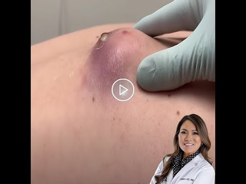 Large Blackheads Cystic Acne Blackheads&Whiteheads Removal Pimple Popping #111931