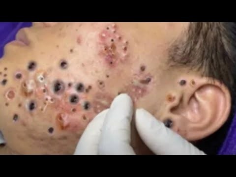 Deep blackhead Removal 2026, acne removal spa, big pimple 2026, #acne #pimple #cyst