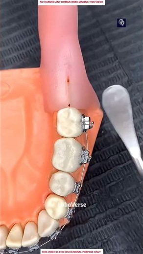 Dentist Removes a Hidden Tooth from the Gum 😱