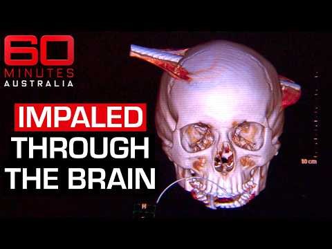 How an 18-year-old survived a steel pole through his head | 60 Minutes Australia