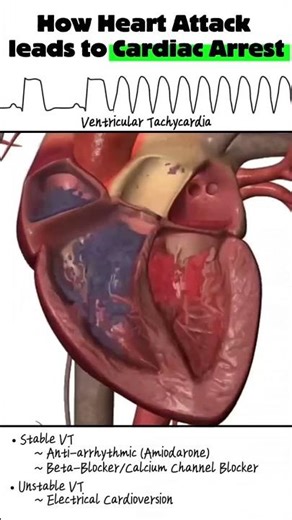 How Heart Attack leads to Cardiac Arrest #cardiacarrest #ecg #heartattack #acls #defibrillator