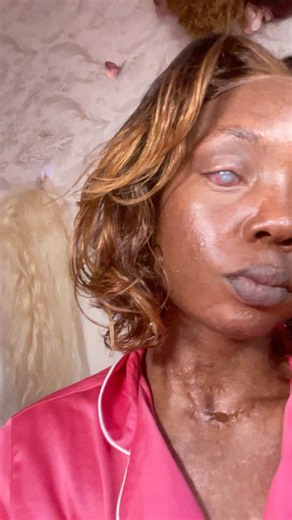 Mental Health After Stevens-Johnson Syndrome: Shaz’s Story and Coping Steps